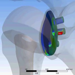 simulation of shoulder implant