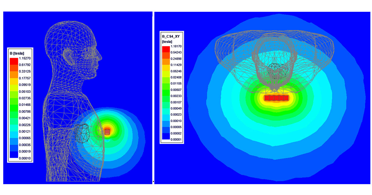 Simulate How Permanent Impact Medical Implants